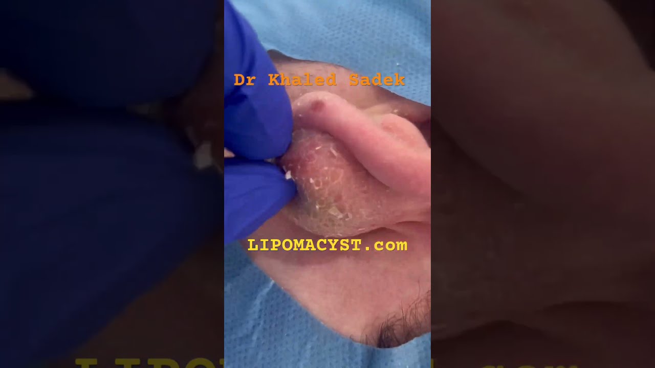 Biggest Ear Cyst Ever Skincare Blackheadremoval Dr Khaled