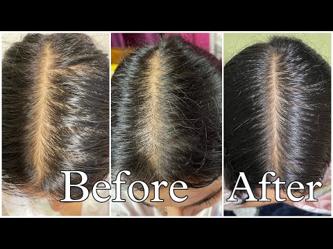 My Honest Hair Loss Journey U0026 How I Fixed It