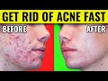 The Causes of Acne - How To Get Rid of Acne Fast | Dr.Berg