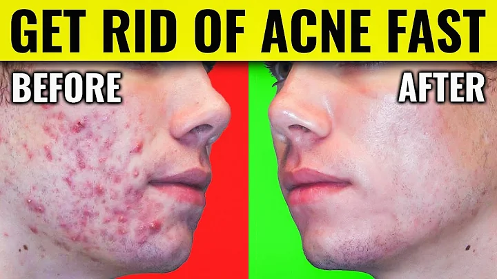 Say Goodbye to Acne: Dr. Berg's Proven Methods for Clearing Your Skin - DayDayNews