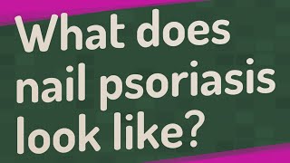 What does nail psoriasis look like?