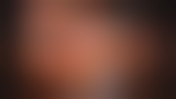 Narrated full-length robotic partial nephrectomy w/ selective clamping & Firefly by Dr. Ronney Abaza