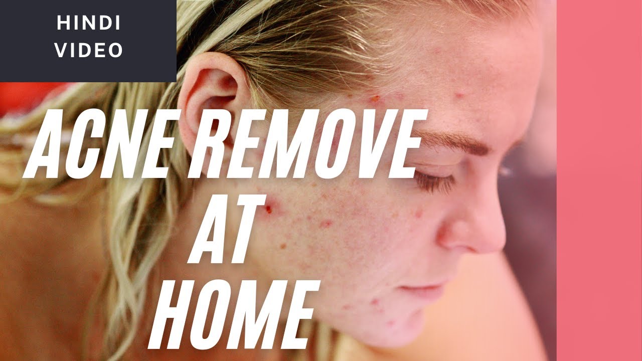 Acne removal at Home | 100% Acne spot remove | Pimples Remove | Hindi