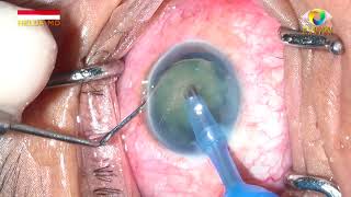 Mature Cataract - Phco Surgery 095