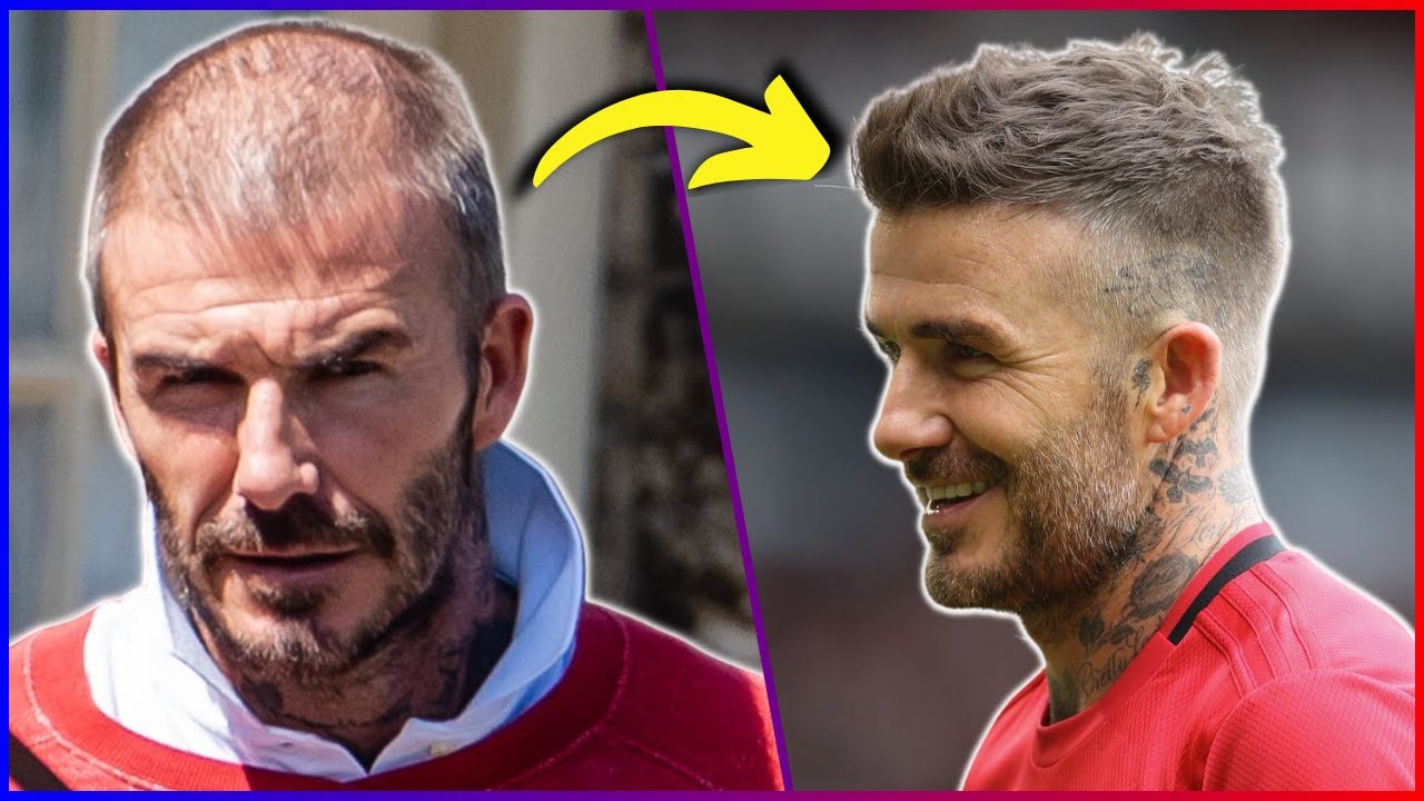 9 Footballers Who Have Undergone Hair Transplants YouTube 9-footballers-who-have-undergone-hair-transplants-youtube