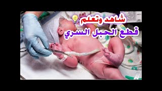 العناية التمريضية بالحبل السوري للطفل حديث الولادة