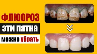 Пятна на зубах можно убрать или почему флюороз - не приговор!