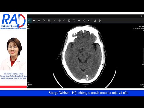 Sturge Weber - Hội chứng u mạch máu da mặt và não