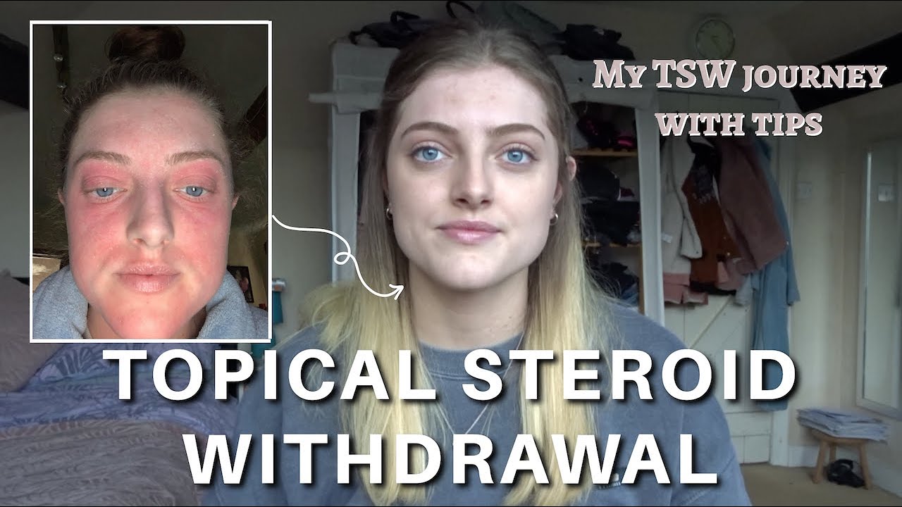 How I healed from TSW and Eczema  - My Topical steroid withdrawal journey with tips and pictures -