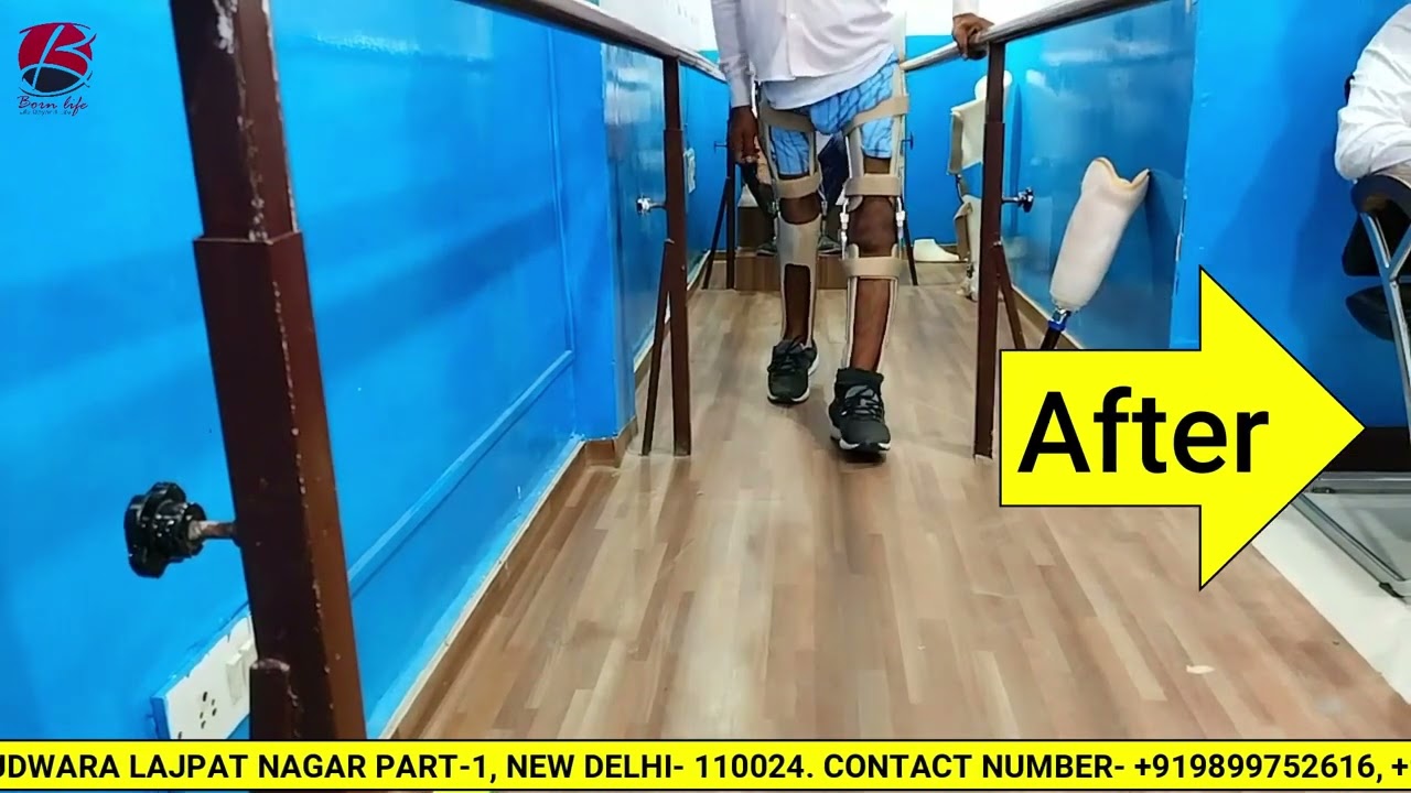 Customize Right and Left Polio Knee Caliper with becker USA knee joint