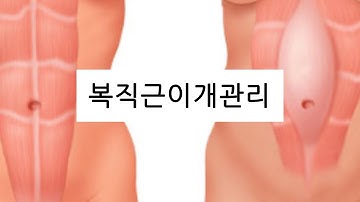 복직근이개 (복직근분리증) 운동 4가지