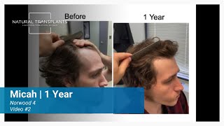 One Year Later: Norwood 4 Incredible Hair Transformation Journey! | Dr. Blumenthal (Micah)