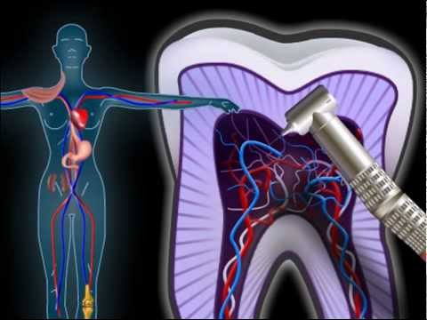 Video: Okluzivna Tromboza - Simptomi In Zdravljenje