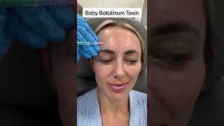 Baby BOTOX at DR MEDISPA