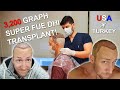 2020 FUE DHI 3200 Graft Hair Transplant From US to Turkey Dr  Cinik PART 1