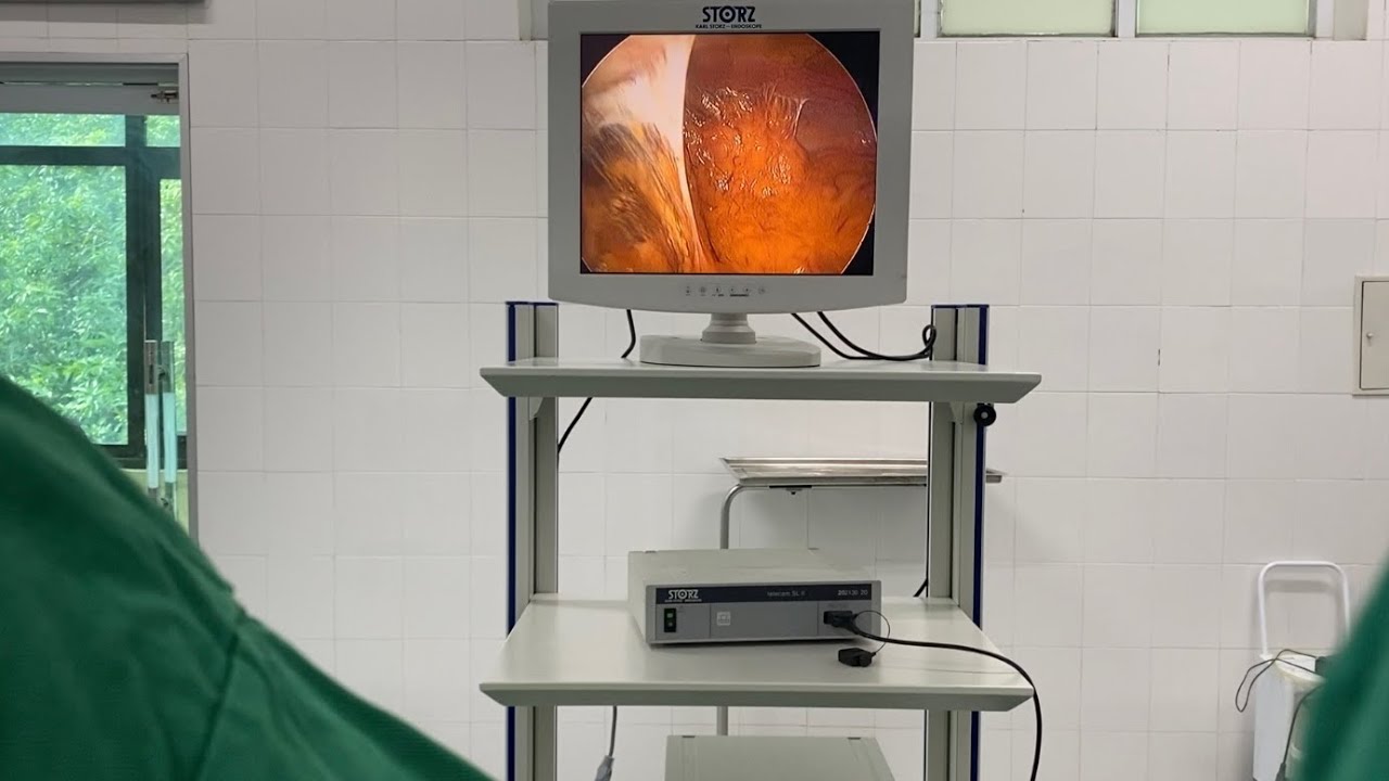 Dính ruột dính mạc nối sau mổ | Cắt ruột thừa viêm có dính ruột sau mổ ...