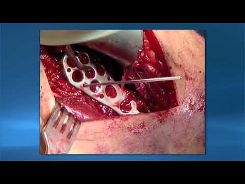 Video: ORIF-kirurgi: Åben Reduktion Intern Fiksering For ødelagte Knogler