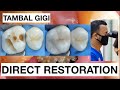 Dental Filling Composite Direct Restoration Upper Molar Class II | General Dentist Griya RR
