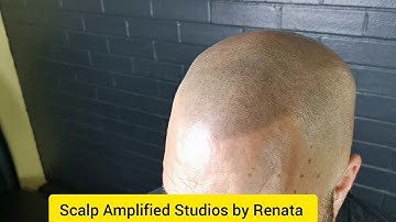 Scalp Micropigmentation (SMP)... Healed 2nd session