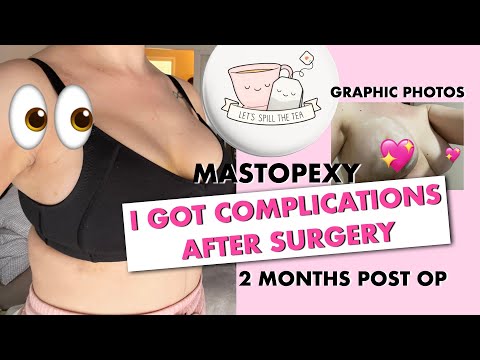 Spilling the TEA About Complications After my Breast Lift Surgery | Graphic PHOTOS Ep. 3