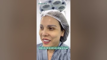 Kết quả căng da mặt nội soi Smas