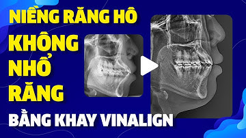 Niềng Răng Hô Không Cần Nhổ Răng Bằng Khay Vinalign | Nam Bùi Vinalign