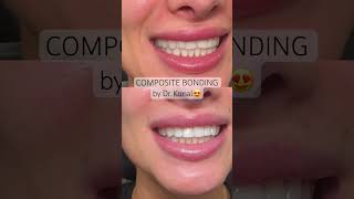 Composite bonding completed in a single appointment by Dr. Kunal 😍 #ruhdental #compositebonding
