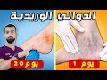 علاج الدوالي وانتفاخ الارجل تعرف على طريقه العلاج النهائي بدون جراحه علاج الدوالي وانتفاخ الارجل تعرف على طريقه العلاج النهائي بدون جراحه