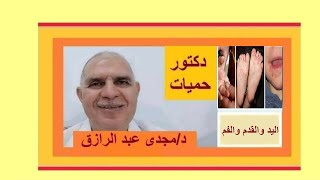 علاج مرض اليد والقدم والفم عند الأطفال  HAND  FOOT AND MOUTH DISEASE TREATMENT IN CHILDREN