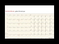 Quiz : Infarctus ou pericardite ?