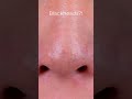 Goodbye, pesky backheads! This DIY Blackhead mask will get rid of them all! #shorts