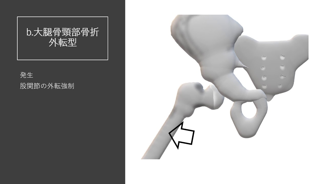 柔道整復理論　大腿骨近位部骨折
