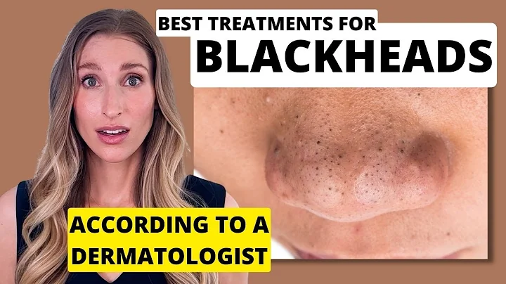 Blackheads: Dermatologist Shares Best Treatments to Remove Them with Affordable Skincare Options - DayDayNews