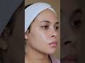 #kopher #dermskincare #sossystem #acne #acneskin #4everline