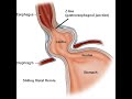 Diaphragmatic (Hiatal) Hernias: Week #10, Winter 2020, Lecture #1