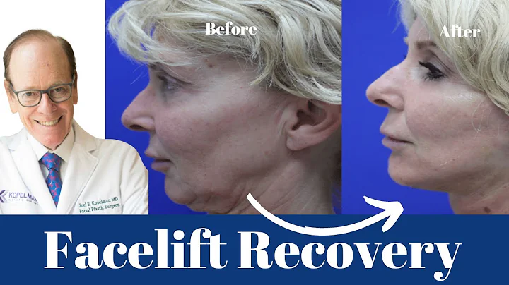 Facelift Recovery: A Comprehensive Guide | Dr. Joel Kopelman