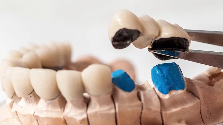 FAQ - How can I replace a missing tooth? | Dr. Mar...