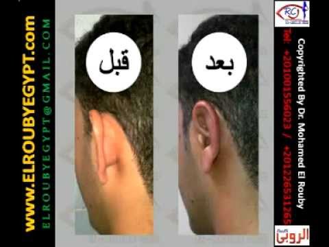 مشاكل عملية تجميل الاذن جراحة تجميل