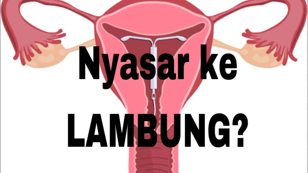 IUD nyasar ke Lambung?