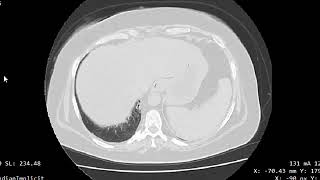 CASE 962 CT Chest post Covid19