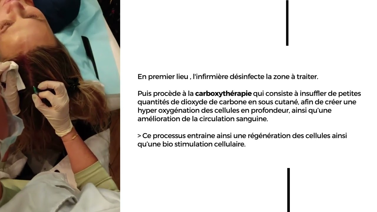 Carboxythérapie et LEDs : un protocole de choix pour lutter contre la chute des cheveux ?