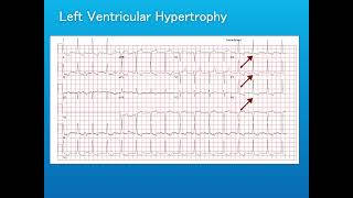 ECG interpretation T waves & abnormality