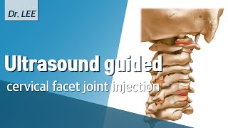 Ultrasound-guided cervical facet joint injection, in-plane approach, technique, and weak points