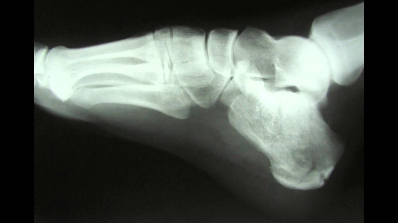 X Ray Pictures Of Broken Bones - 1920x1080 - jpeg X Ray Pictures Of Broken Bones
