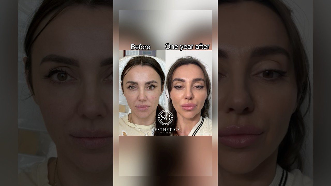 Sculptra -collagen stimulator.