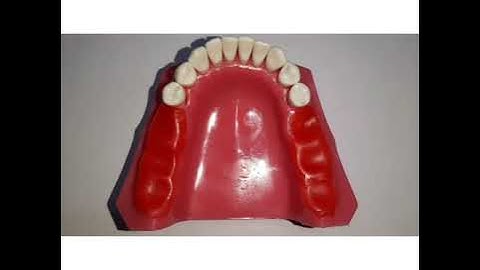 IMPRESSION TECHNIQUES IN REMOVABLE PARTIAL DENTURES