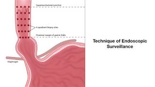 Barrett's esophagus biopsies-Graphic Illustration