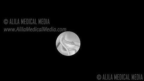 Lumbar Facet Joint Injection Procedure Animation