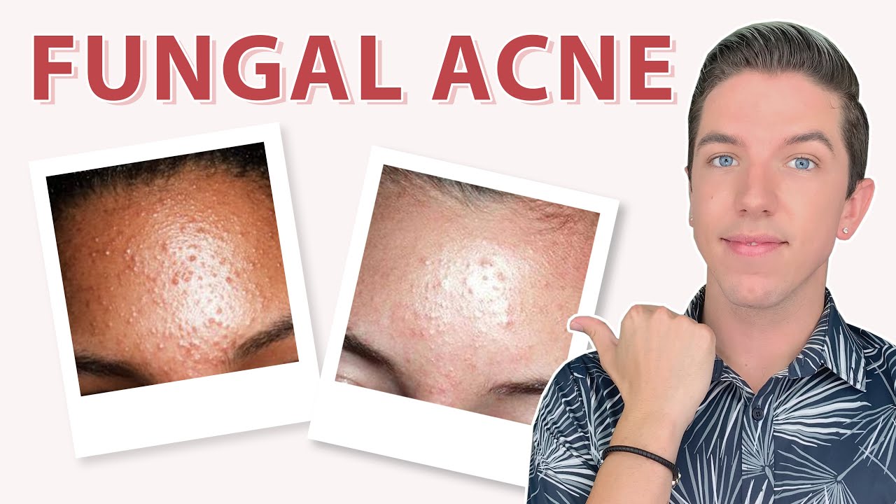 Rid on subclinical acne forehead of get How to
