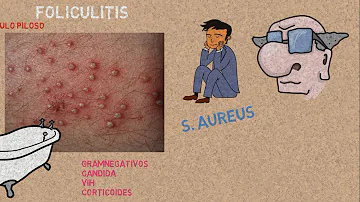 ¿Por qué no desaparece mi foliculitis?